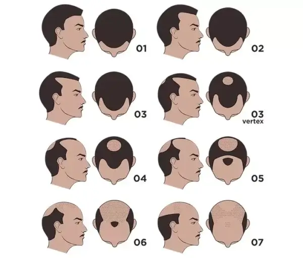 The Norwood Scale for hair loss.