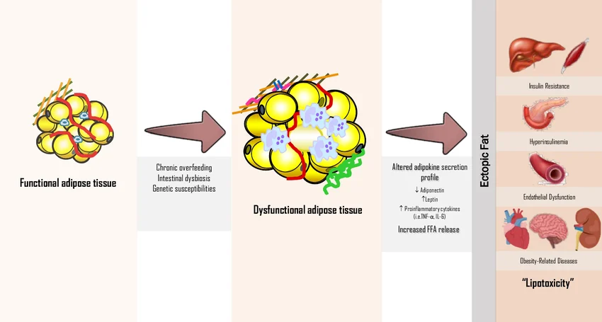Dysfunctional adipose tissue and ectoic fat