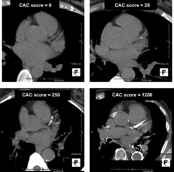 Coronary Artery Calcium Scan (CAC)